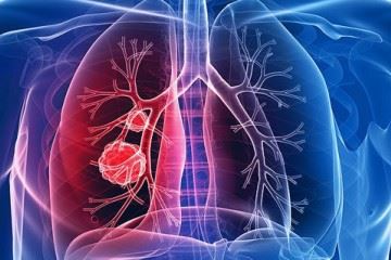 سرطان ریه جزو شایع‌ترین سرطان‌ها در مردان است