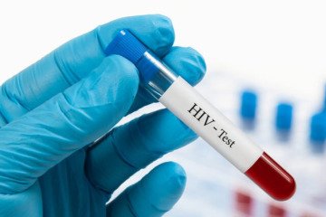 الگوی انتقال ویروس HIV تغییر کرده است