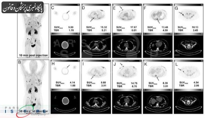 تصویربرداری پت اسکن زودهنگام با رادیوداروی Ga-۶۸-FAP-۲۲۸۶